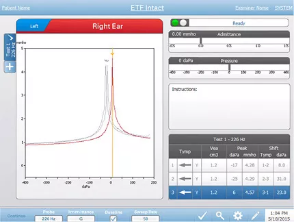 eustachian-tube-function-testing-screen